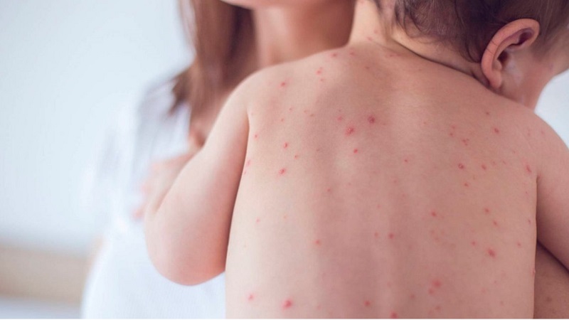 Sarampión: niños de 13 meses a 4 años deberán volver a vacunarse