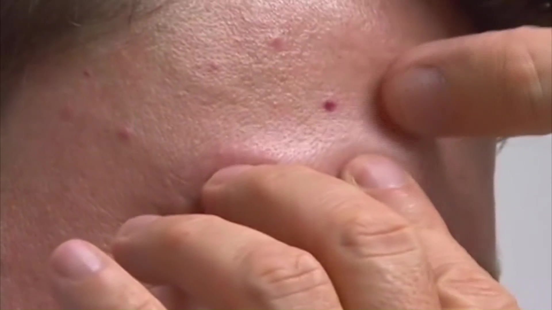 Cuidados de la piel: los casos de cáncer de piel continúan en ascenso en Misiones